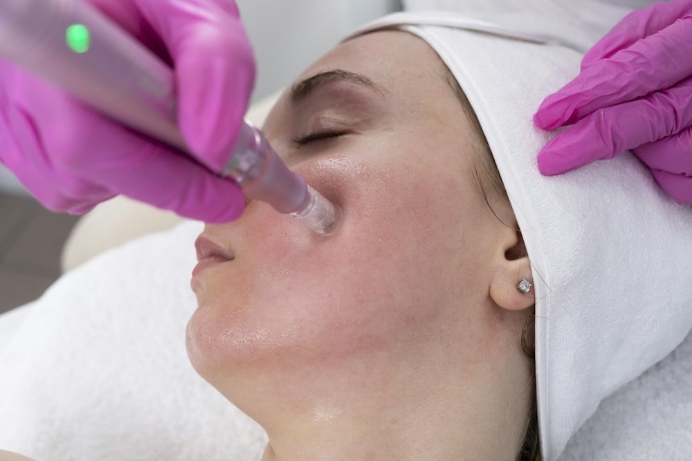 Tratamento facial com microagulhamento